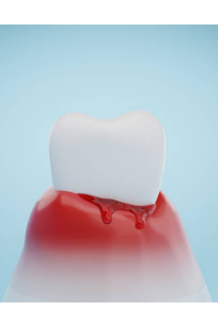 歯周病